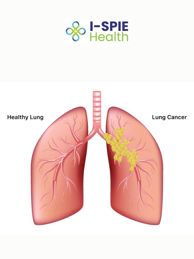 Can You Survive Lung Cancer If Detected Early? A Guide to Your Life